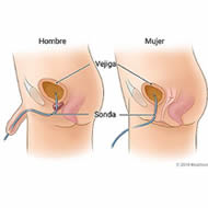 sonda-foley-enfermeriatucasa-cl